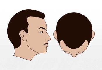 Haartransplantation 1500-2000 graft