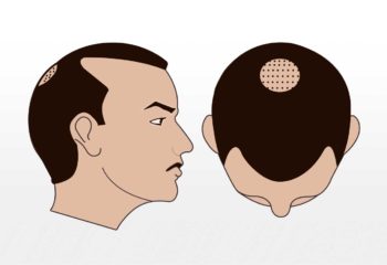 Haartransplantation 2000-2500 graft