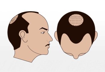 Haartransplantation 2500-3000 graft