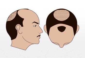 Haartransplantation 2800-3300 graft