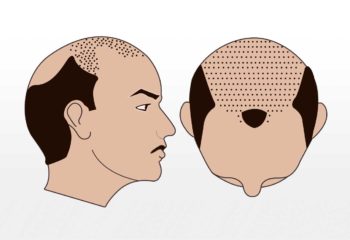 Haartransplantation 3000-3500 graft