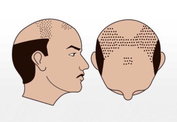 Haartransplantation 4000-7000 grafts