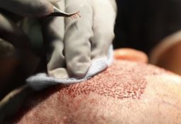 Haartransplantation FUE Entnahme Methoden