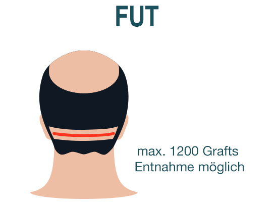 Haartransplantation FUE und FUT