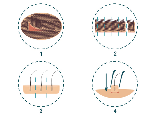 Haartransplantation FUT Technik