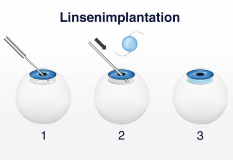 linsenimplantation Türkei