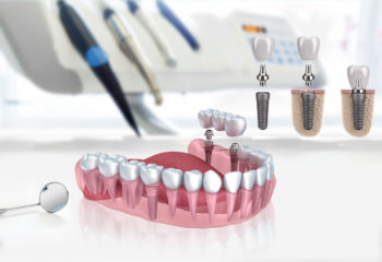 Zahnimplantat Türkei