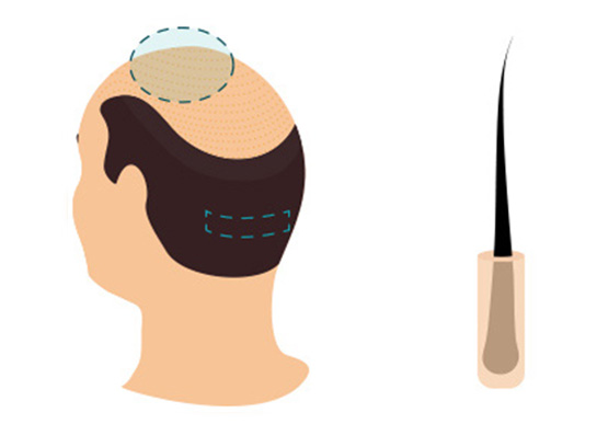 Haartransplantation FUT Technik