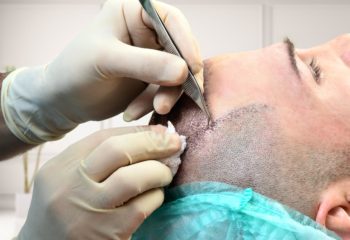 Haartransplantation Manuel