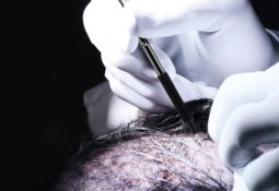 Haartransplantation Perkutan