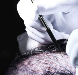 Haartransplantation Perkutan