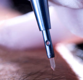 Haartransplantation Saphir Methode