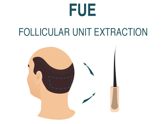 haartransplantation fue methode 1