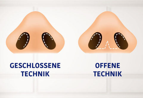 Geschlossene Nasenkorrektur