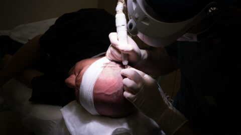 Haartransplantation Technik