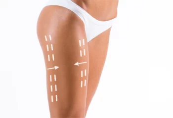 Fettabsaugung Reiterhosen