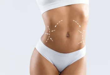 Liposuktion Bauch
