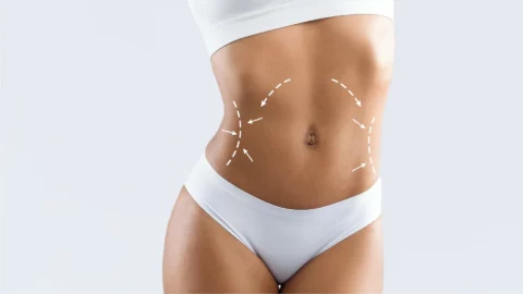 Liposuktion Bauch