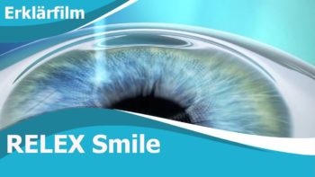 Die ReLEx smile OP anschaulich dargestellt